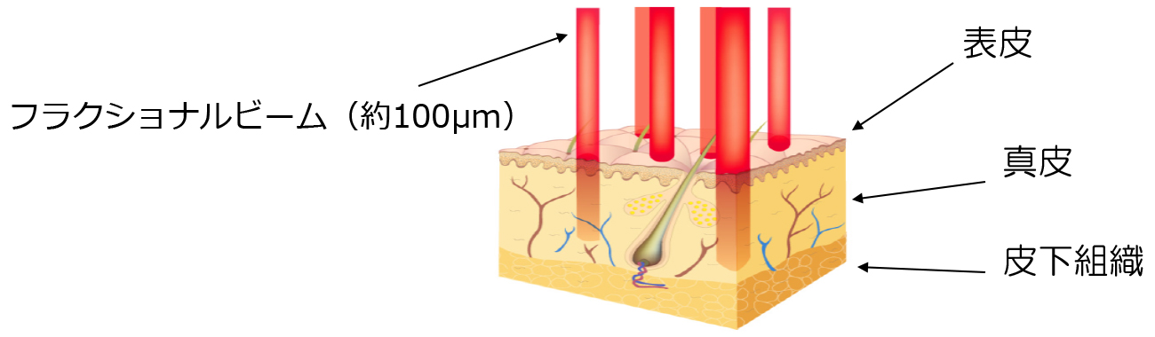 Non-モザイクによるフラクショナル治療とは？