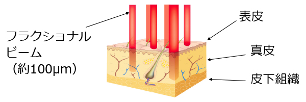 Non-モザイクによるフラクショナル治療とは？